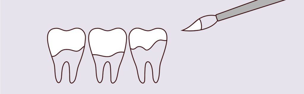 Fluoride Treatments - Pure Gold Professionals in Dentistry - Redlands Dentist - Pure Gold Professionals in Dentistry - Redlands Dentist -