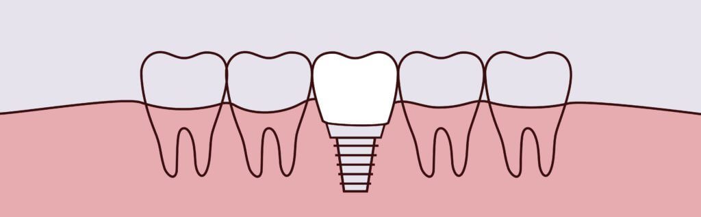 Dental Implants - Pure Gold Professionals in Dentistry - Redlands Dentist - Pure Gold Professionals in Dentistry - Redlands Dentist -
