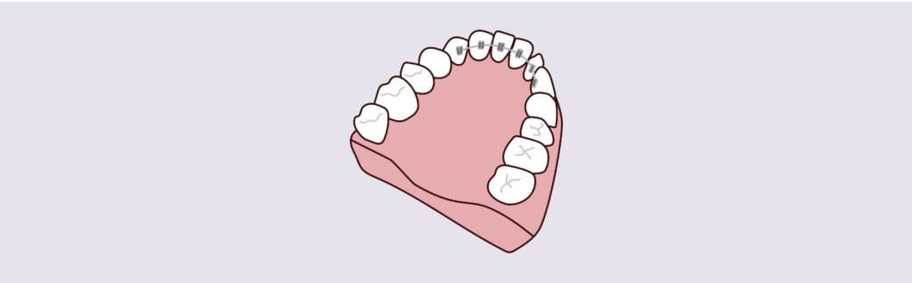 Lingual Braces - Pure Gold Professionals in Dentistry - Redlands Dentist - Pure Gold Professionals in Dentistry - Redlands Dentist -