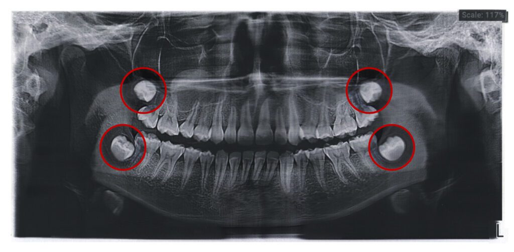 wisdom teeth removal wisdom tooth removal orthodontics